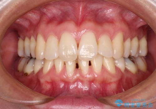 下顎前歯の歯肉退縮 歯肉移植による根面被覆の治療前