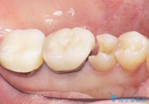 詰め物の境目が黒くて気になる 40代女性の治療中