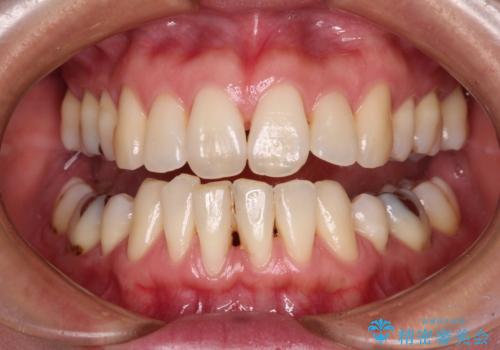 下顎前歯の歯肉退縮 歯肉移植による根面被覆の治療前