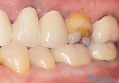 詰め物の境目が黒くて気になる 40代女性の治療中