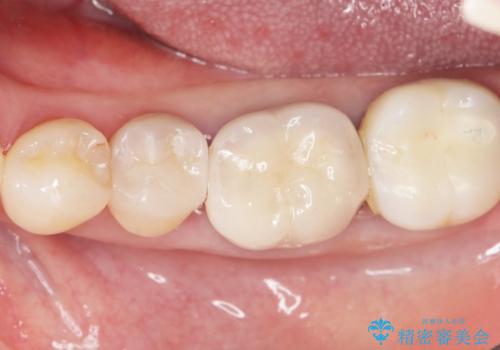 詰め物の境目が黒くて気になる 40代女性の治療後