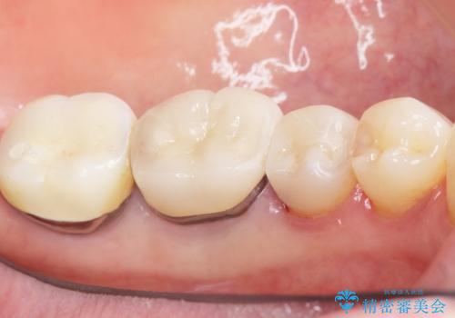 詰め物の境目が黒くて気になる 40代女性の治療後