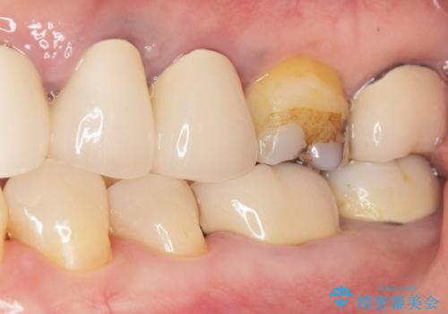 詰め物の境目が黒くて気になる 40代女性の治療後