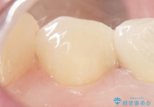 詰め物の境目が黒くて気になる 40代女性の治療後