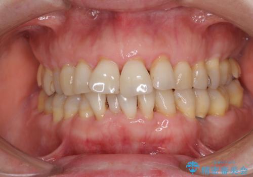 口元の出っ張りとデコボコを改善したいの治療前