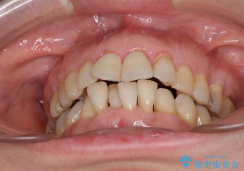 口元の出っ張りとデコボコを改善したいの治療前