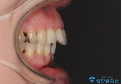 口元の出っ張りとデコボコを改善したいの治療前