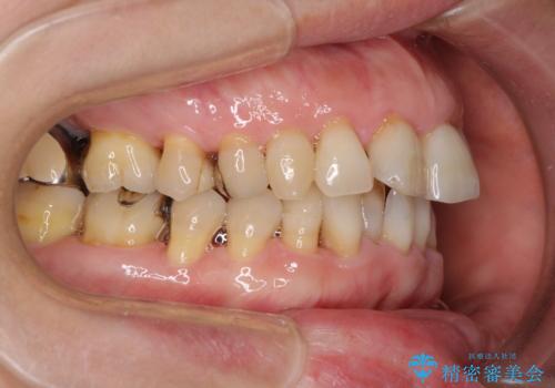 口元の出っ張りとデコボコを改善したいの治療前