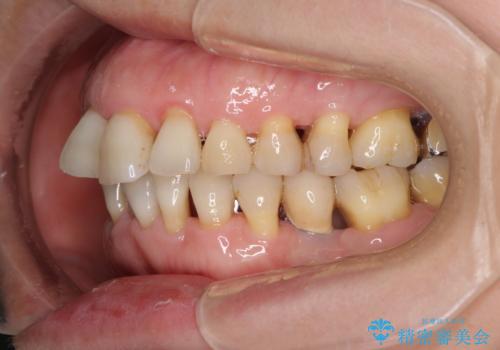 口元の出っ張りとデコボコを改善したいの治療前