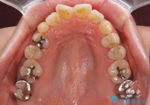 口元の出っ張りとデコボコを改善したいの治療前