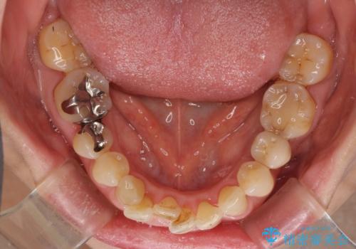 口元の出っ張りとデコボコを改善したいの治療前