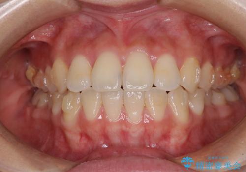 ワイヤー矯正を併用し、リスクを回避しながらのインビザライン矯正治療の治療中