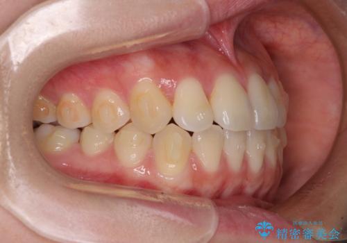 ワイヤー矯正を併用し、リスクを回避しながらのインビザライン矯正治療の治療中