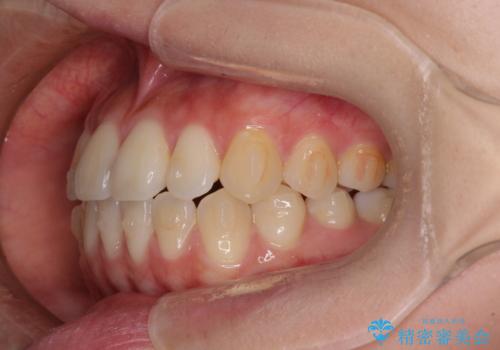 ワイヤー矯正を併用し、リスクを回避しながらのインビザライン矯正治療の治療中