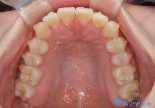 ワイヤー矯正を併用し、リスクを回避しながらのインビザライン矯正治療の治療中