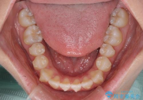 ワイヤー矯正を併用し、リスクを回避しながらのインビザライン矯正治療の治療中