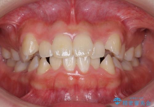 八重歯・前歯のがたつき 抜かない矯正 インビザラインでの治療前