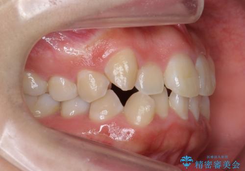 八重歯・前歯のがたつき 抜かない矯正 インビザラインでの治療前