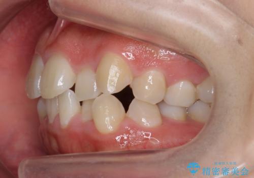 八重歯・前歯のがたつき 抜かない矯正 インビザラインでの治療前