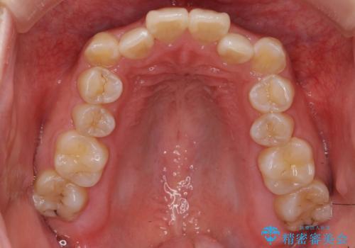 八重歯・前歯のがたつき 抜かない矯正 インビザラインでの治療前