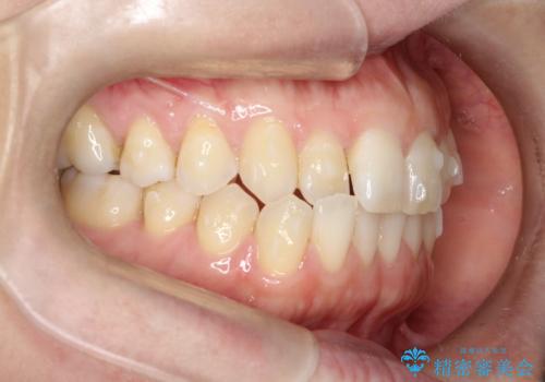 上の歯と下の歯が反対にかんでいる インビザラインによる目立たない矯正の治療中