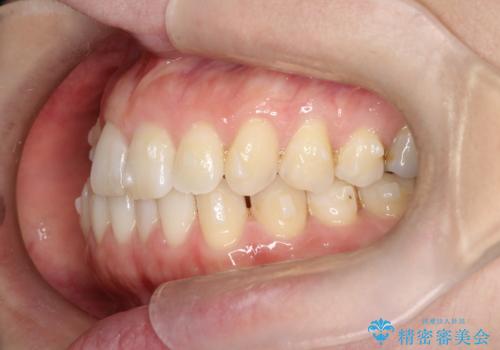 上の歯と下の歯が反対にかんでいる インビザラインによる目立たない矯正の治療中