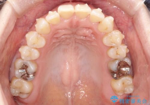 上の歯と下の歯が反対にかんでいる インビザラインによる目立たない矯正の治療中