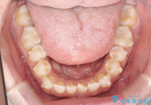 上の歯と下の歯が反対にかんでいる　インビザラインによる目立たない矯正の治療中