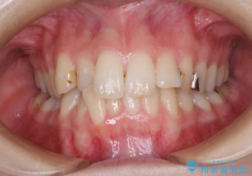 短期間での治療 急速拡大装置を併用したワイヤー装置による矯正治療の症例 治療前