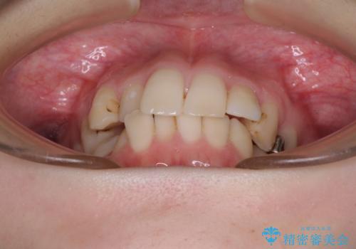 短期間での治療 急速拡大装置を併用したワイヤー装置による矯正治療の治療前