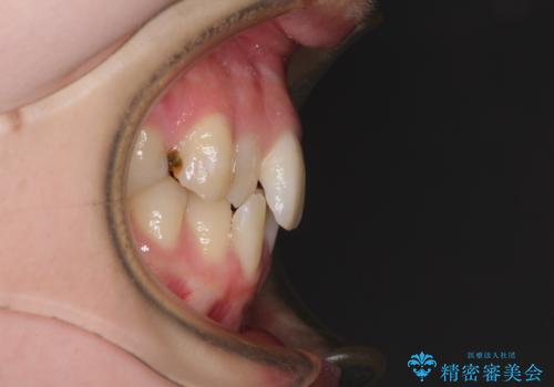 短期間での治療 急速拡大装置を併用したワイヤー装置による矯正治療の治療前