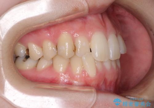 短期間での治療 急速拡大装置を併用したワイヤー装置による矯正治療の治療前