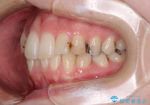 短期間での治療 急速拡大装置を併用したワイヤー装置による矯正治療の治療前