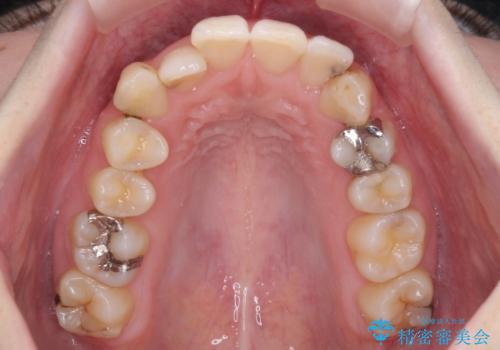 短期間での治療 急速拡大装置を併用したワイヤー装置による矯正治療の治療前