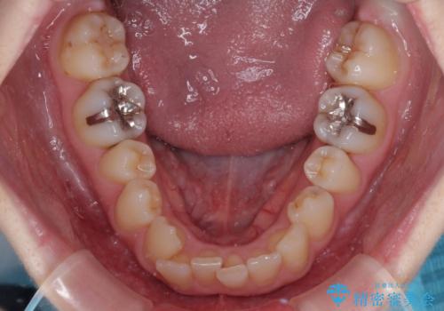 短期間での治療 急速拡大装置を併用したワイヤー装置による矯正治療の治療前
