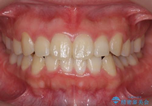 八重歯・前歯のがたつき　抜かない矯正　インビザラインでの症例 治療後