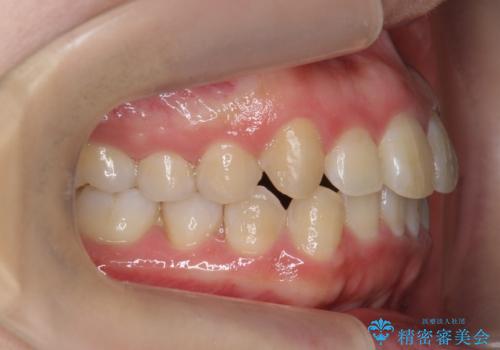 八重歯・前歯のがたつき　抜かない矯正　インビザラインでの治療後