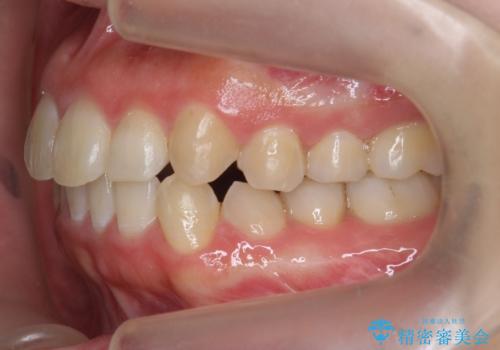 八重歯・前歯のがたつき 抜かない矯正 インビザラインでの治療後