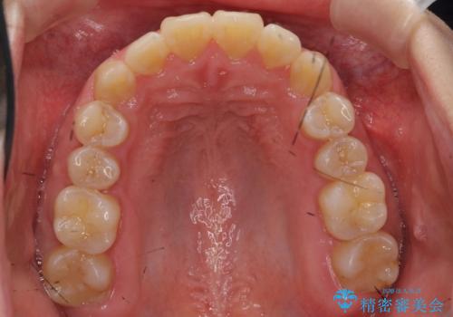 八重歯・前歯のがたつき　抜かない矯正　インビザラインでの治療後