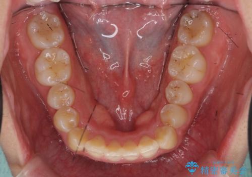 八重歯・前歯のがたつき 抜かない矯正 インビザラインでの治療後