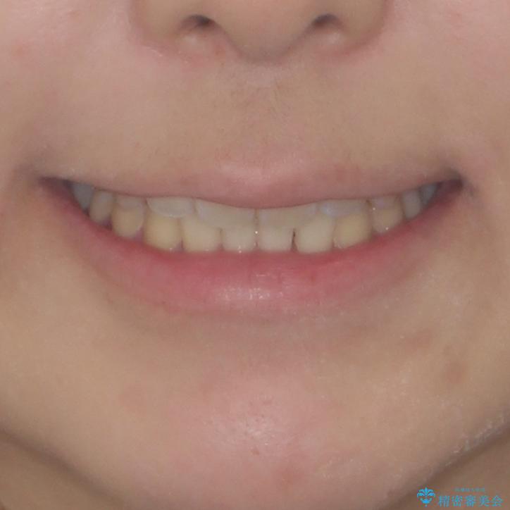 補助装置を使ったインビザラインによる抜歯矯正の治療後（顔貌）