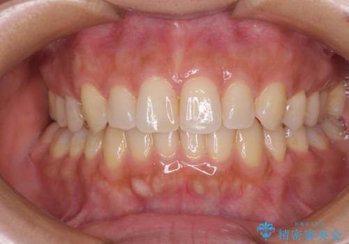 沖縄から飛行機で通院 インビザラインによる矯正治療の治療中