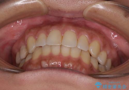 沖縄から飛行機で通院 インビザラインによる矯正治療の治療中