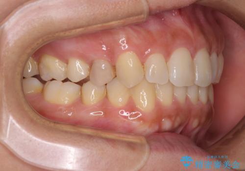 沖縄から飛行機で通院 インビザラインによる矯正治療の治療中