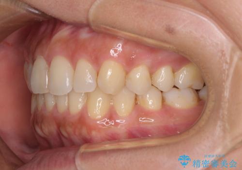 沖縄から飛行機で通院 インビザラインによる矯正治療の治療中