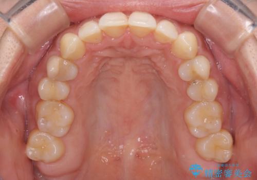 沖縄から飛行機で通院 インビザラインによる矯正治療の治療中
