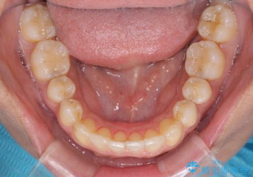 沖縄から飛行機で通院 インビザラインによる矯正治療の治療中