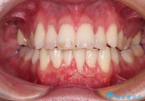 ほぼ歯根全てが露出　2度の歯肉移植術で自然な見た目にの治療後
