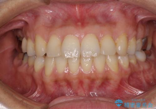 痛む奥歯と矯正の後戻り インビザライン・ライトとセラミック治療の治療前