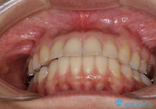 痛む奥歯と矯正の後戻り インビザライン・ライトとセラミック治療の治療前